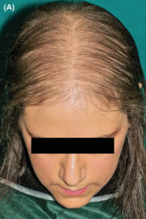 Alopecia Before Treatment